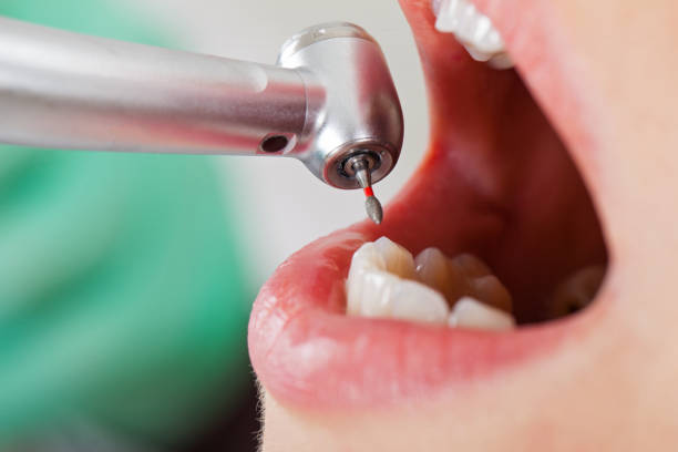 Best Emergency Dental Extractions in Home, WA